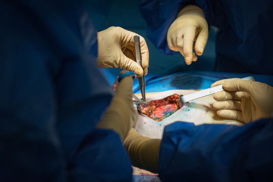 BREAST CANCER SURGERY