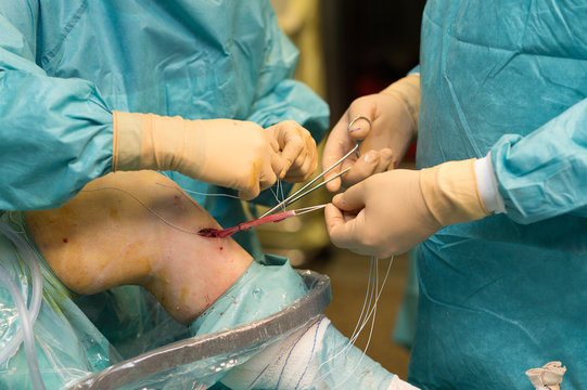 LIGAMENT SURGERY