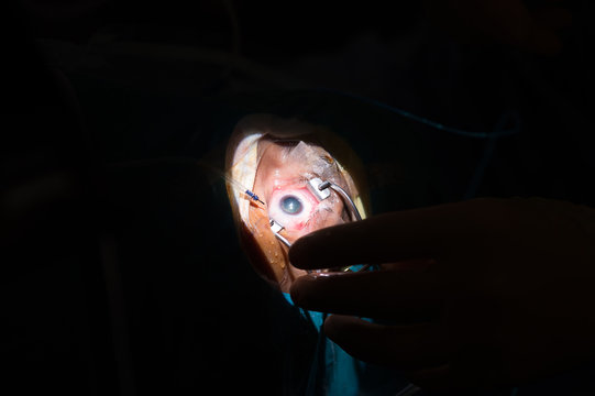RETINAL DETACHMENT SURGERY