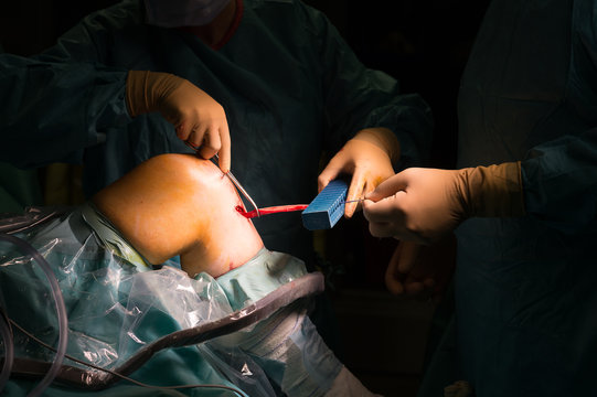 LIGAMENT SURGERY