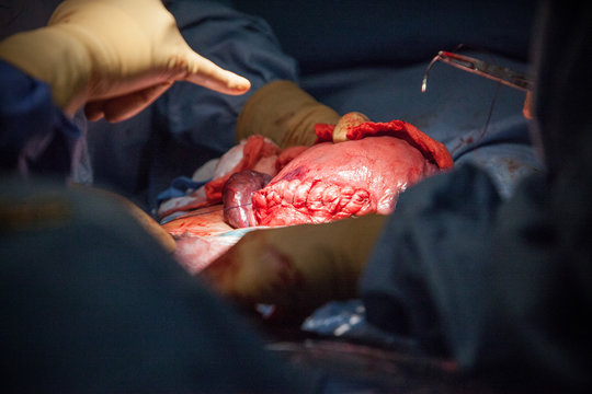 CESAREAN BIRTH
