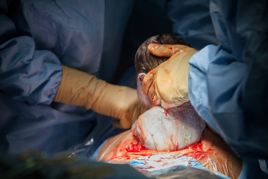 CESAREAN BIRTH