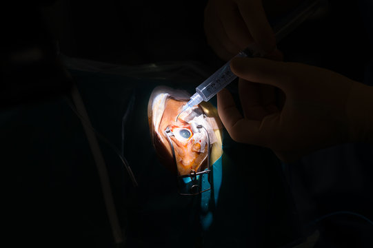 RETINAL DETACHMENT SURGERY
