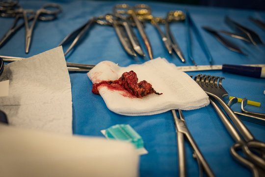 BREAST CANCER SURGERY