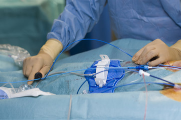 RADIOFREQUENCY ABLATION