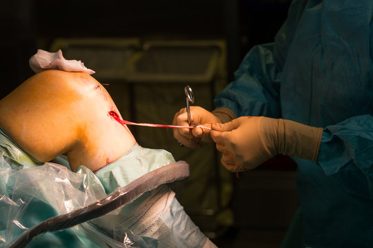 LIGAMENT SURGERY
