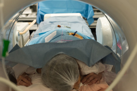 VERTEBROPLASTY