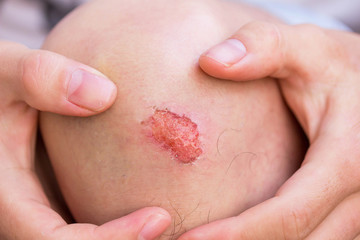 Man show lesion or wound on his knee after accident
