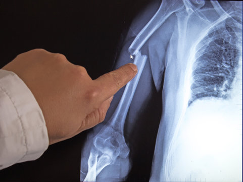 X-ray image of broken arms