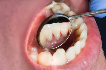 Plaque of the patient, stone. Dentistry treatment of dental plaque, professional oral hygiene. The...
