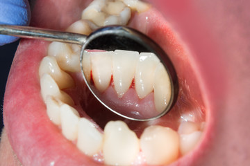 Plaque of the patient, stone. Dentistry treatment of dental plaque, professional oral hygiene. The...