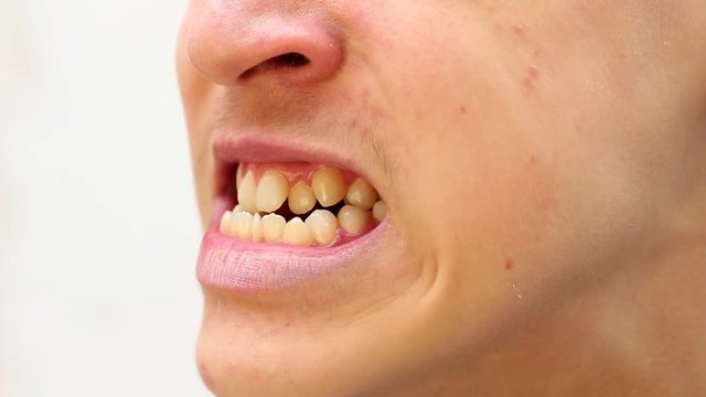 A person to have a bad bite. A malocclusion happens when mismatched teeth and the jaw cause a person to have a bad bite