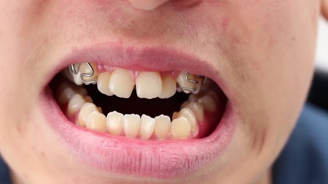 Malocclusion. Correcting such problems. Bite correction. Fixed appliance such as braces used to move the teeth in the jaws
