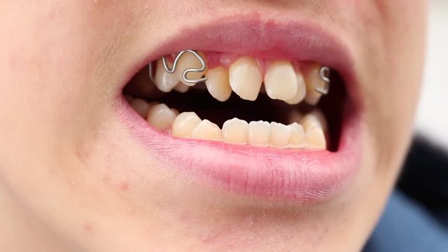 A person to have a bad bite. Bad bite. Wearing removable retainer. Fixed appliance such as braces used to move the teeth in the jaws