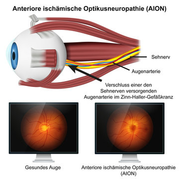Anteriore isch&auml;mische Optikusneuropathie , AION mit Bild vom Augenhintergrund