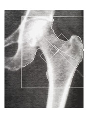 Bone density medical scan - hip. Osteoporosis diagnosis.