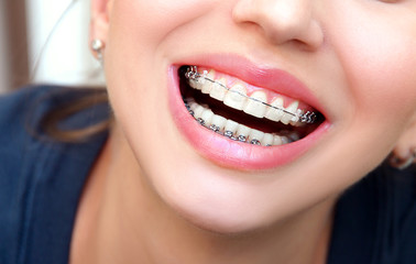 Closeup female smile with ceramic braces teeth.
Orthodontic treatment.