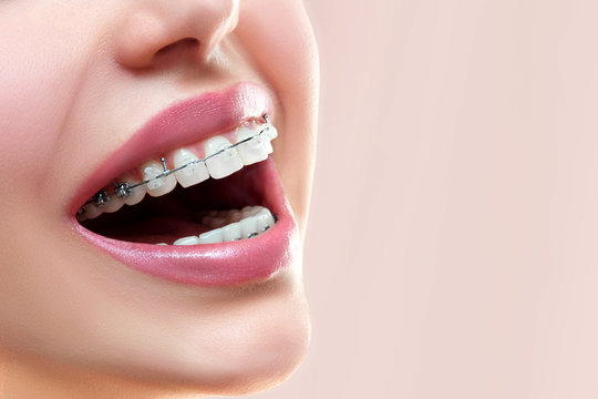 Close up open mouth with Ceramic and Metal Braces on beautiful Teeth. Broad Smile with Self-ligating Brackets. Orthodontic Treatment. Woman Smiling Showing Dental Braces..
