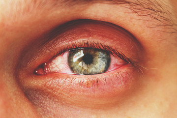 red eye of a patient with human conjunctivitis, retro toned - obrazy, fototapety, plakaty