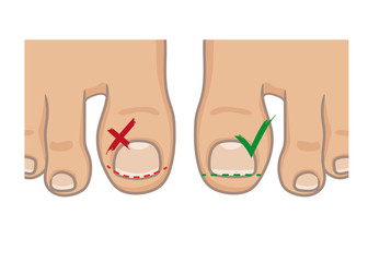 How to cut toenails, right and wrong concept. How to avoide ingrown nail. Female or male foot sole, barefoot, top view. Vector illustration, hand drawn cartoon style isolated on white.