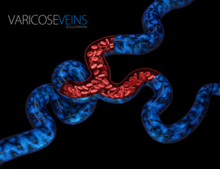 3d Illustration of Varicose veins close up. Human legs on a black background