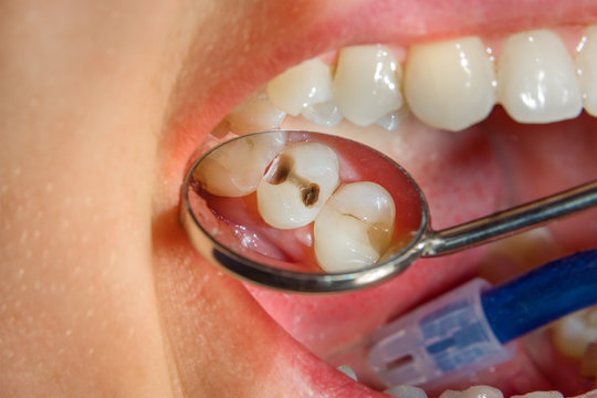 Dental treatment in dental clinic. Rotten carious tooth macro. Treatment endodontic canals