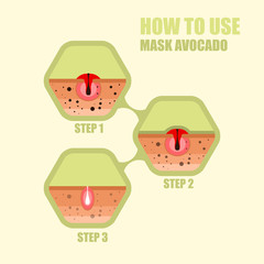 Modern vector illustration of skin problems. Dark dots, acne. Fa