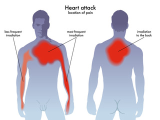 medical vector illustration of heart attack pain location