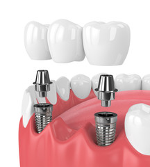 3d render of jaw and implants with dental bridge