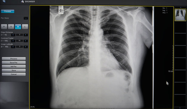 black and white body , rib ,lung , heart , film X-ray .
