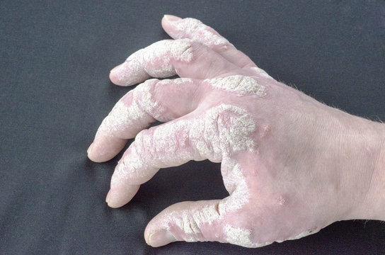 exacerbation of psoriasis on the hands on a gray background