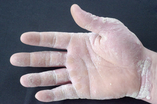 exacerbation of psoriasis on the hands on a gray background
