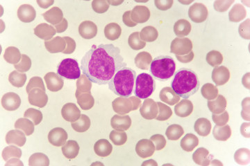 Leukemia cells in blood smear, analyze by microscope
