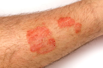 Psoriasis. Alergic rashes on the skin close up. The concept of treating the disease