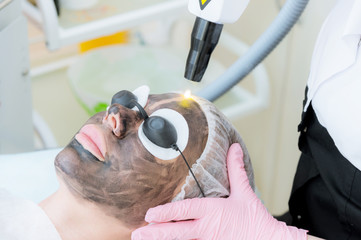 Close-up carbon face peeling procedure. Laser pulses clean skin of the face. Hardware cosmetology...