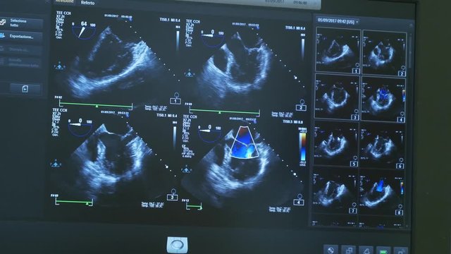 dettagli del cuore visti sul monitor di un pc in un reparto di cardio chirurgia