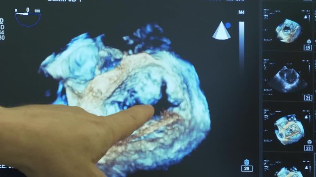 dettagli del cuore visti sul monitor di un pc in un reparto di cardio chirurgia