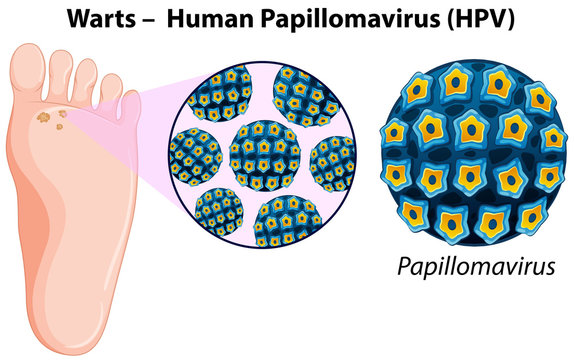 Diagram showing warts in human foot