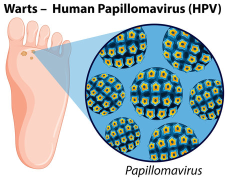 Diagram showing human papillomavirus