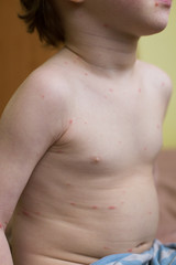 Fototapeta na wymiar Boy with chicken pox rash. Red spots on children's skin