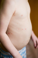 Baby with chicken pox rash. Varicella virus or Chickenpox bubble rash on child. Dermatology concept. Toddler shows blemishes on his belly