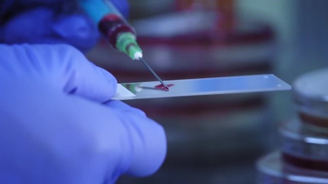 AIDS / HIV Hospital blood test. Preparing a blood sample to analyse it with a microscope