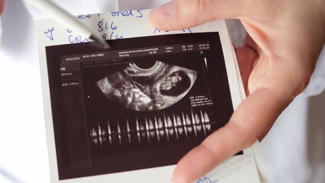 doctor showing embryo, child on printout of ultrasound examination