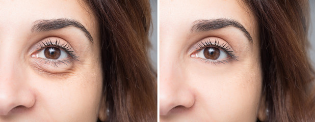 Woman face before and after blepharoplaty, eye with and without puffiness