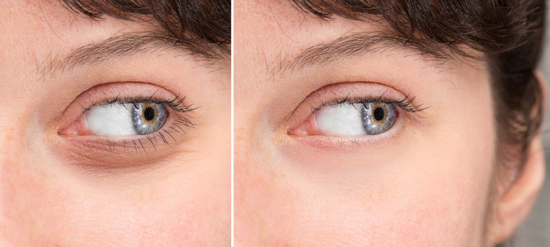 Girl's eyes before and after eyelid surgery