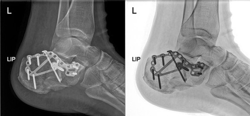 accident anatomy and ankle blood bone broken calcaneus care diagnosis doctor doctors examination...