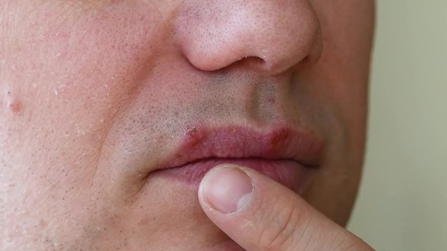 herpes simplex virus infection. Lips treatment by cream. Male face. slow motion