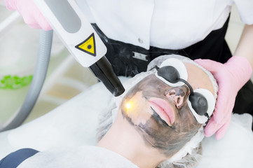 Close-up carbon face peeling procedure. Laser pulses clean skin of the face. Hardware cosmetology...