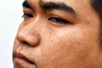 Obraz premium surface young asian man face skin after not get a wink of sleep and do not take care for a long time