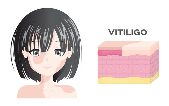 vitiligo women face and skin layer anatomy vector